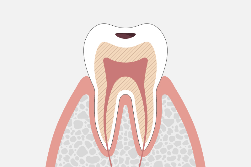 エナメル質内の虫歯